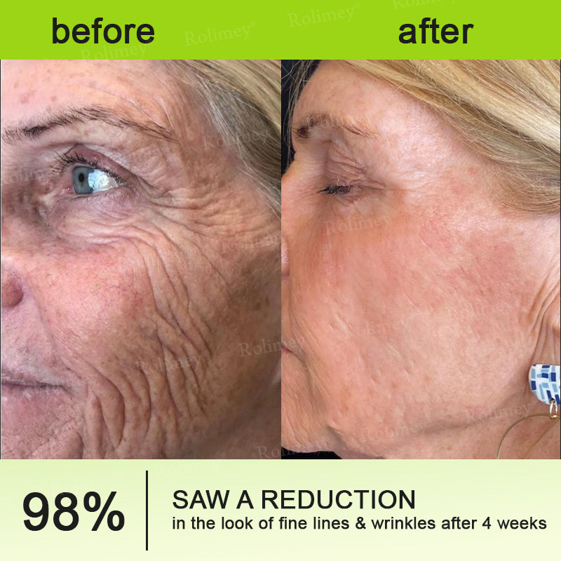 🍀👨‍⚕️Made and shipped from Australia 💫Rolimey® Botox & Vita-A Retinol Shot Wrinkle-Lift Tightening cream - Last Day Promotion 70% OFF Upsell
