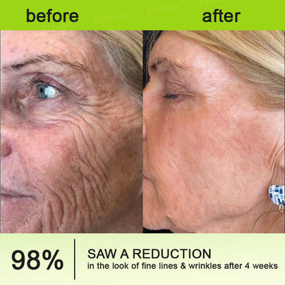 🍀👨‍⚕️Made and shipped from Australia 💫Rolimey® Botox & Vita-A Retinol Shot Wrinkle-Lift Tightening cream - Last Day Promotion 70% OFF Upsell