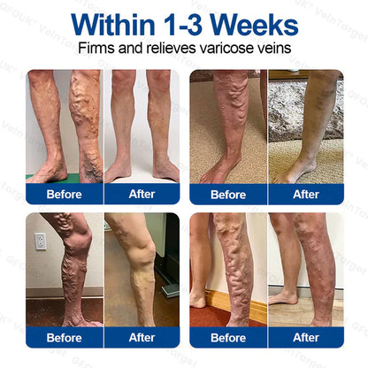 💟💟GFOUK® VeinTarget Microneedle Patch⚡Instant Relief, Long-Term Results